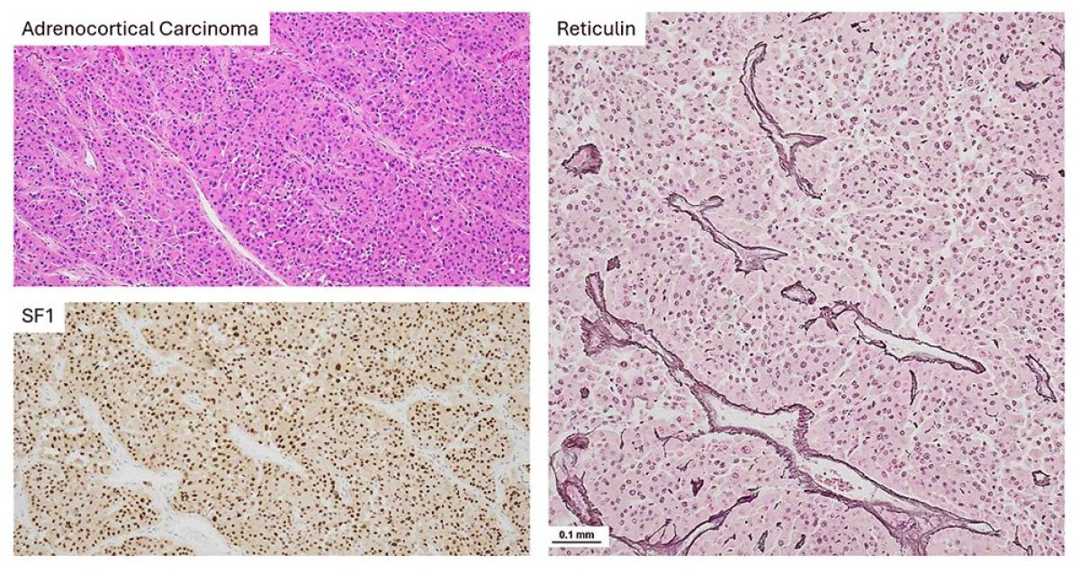 Adrenocortical Carcinoma - fig2