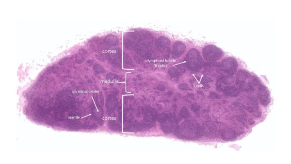 Lymph node with marks