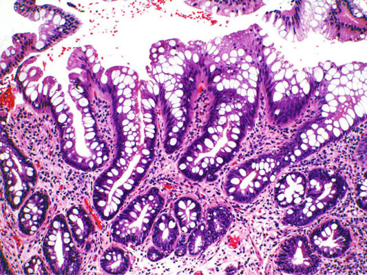 Barretts pathology slide