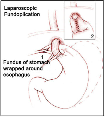 Laparoscopic fundoplication illustration