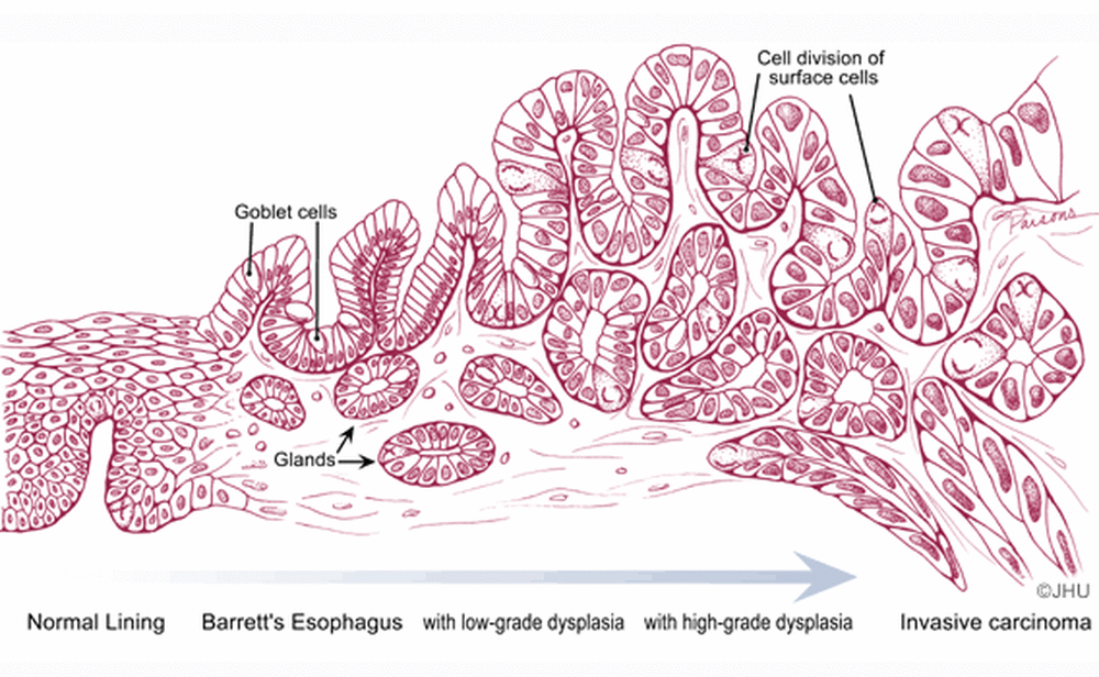 Dysplasia Barrett S Esophagus Johns Hopkins Pathology