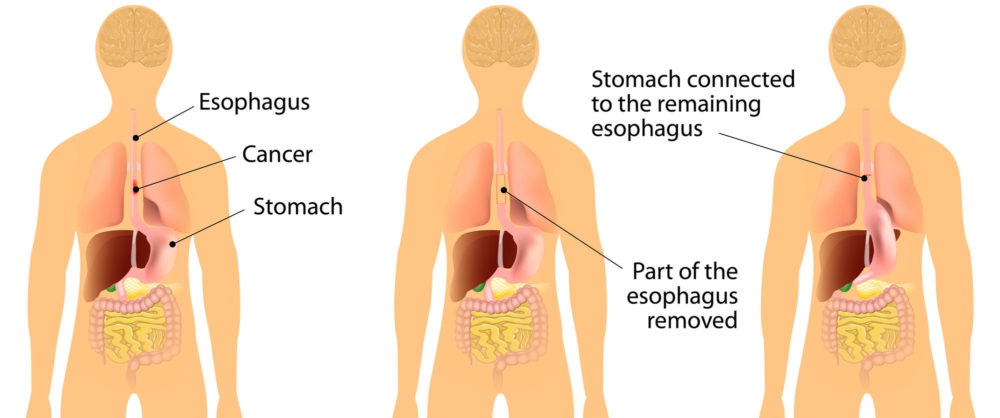 Esophageal cancer illustration