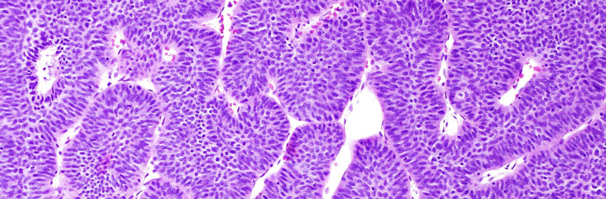 High Grade Papillary Urothelial Carcinoma Meaning