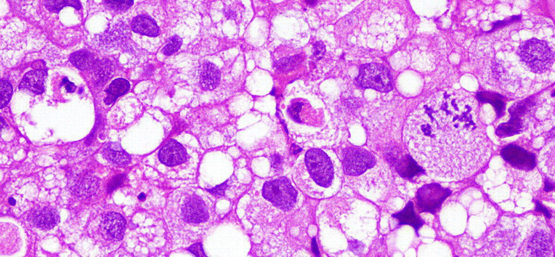 Diagnosis Bladder Cancer Johns Hopkins Pathology