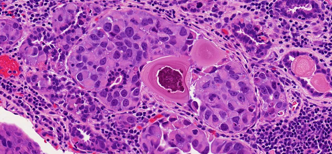 Second Opinions Bladder Cancer Johns Hopkins Pathology