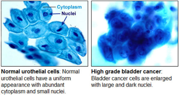 Urine cytology comparison