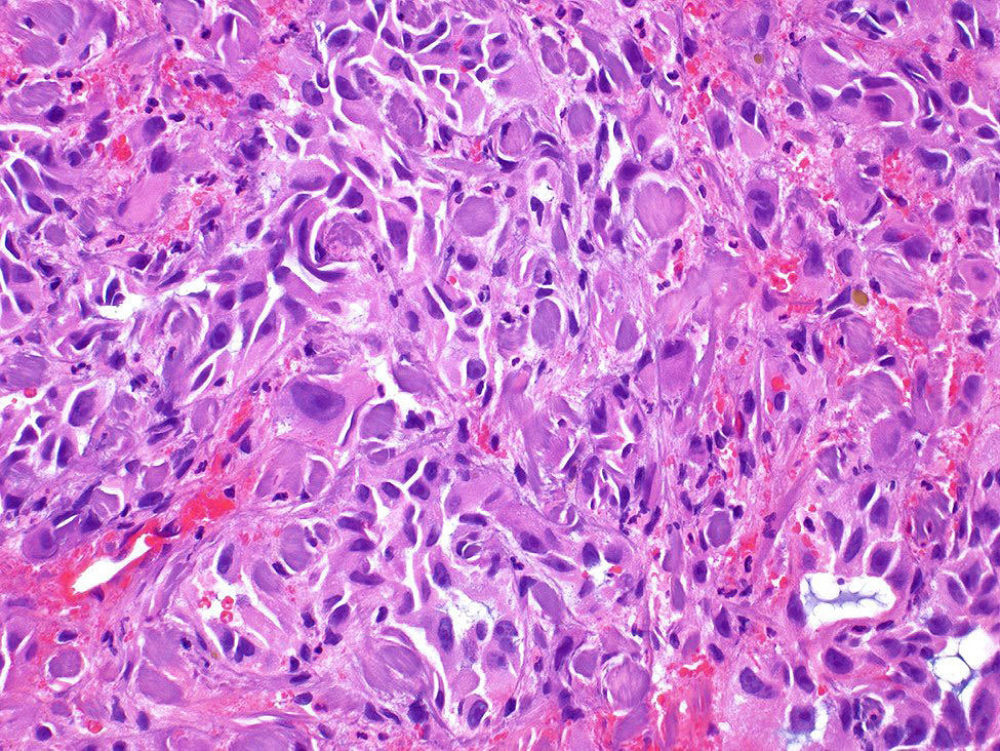 Epithelioid angiosarcoma