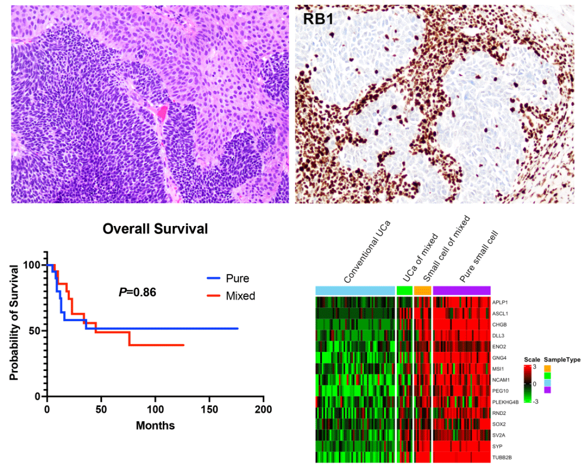 Small cell carcinoma