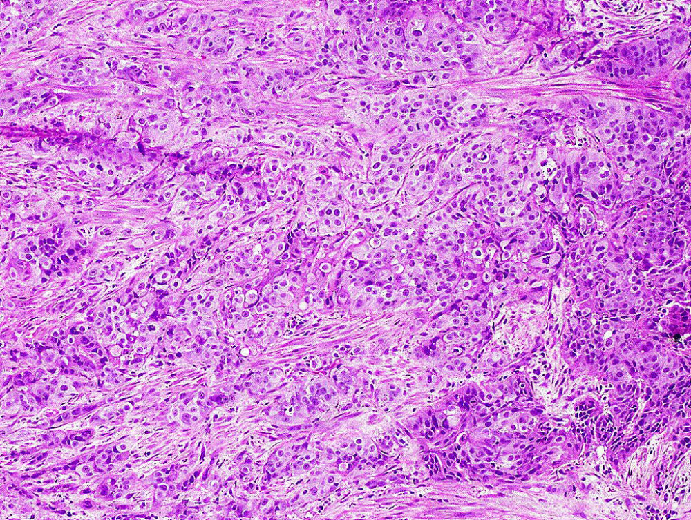 Urothelial carcinoma