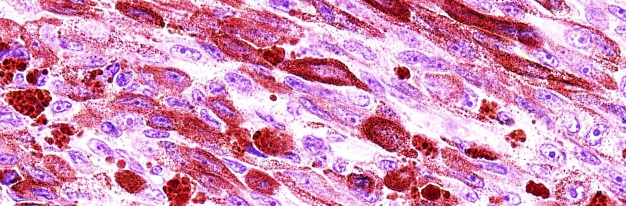 Brain Tumor Pathology Slide