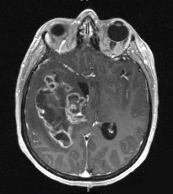 Brain Tumor Scan