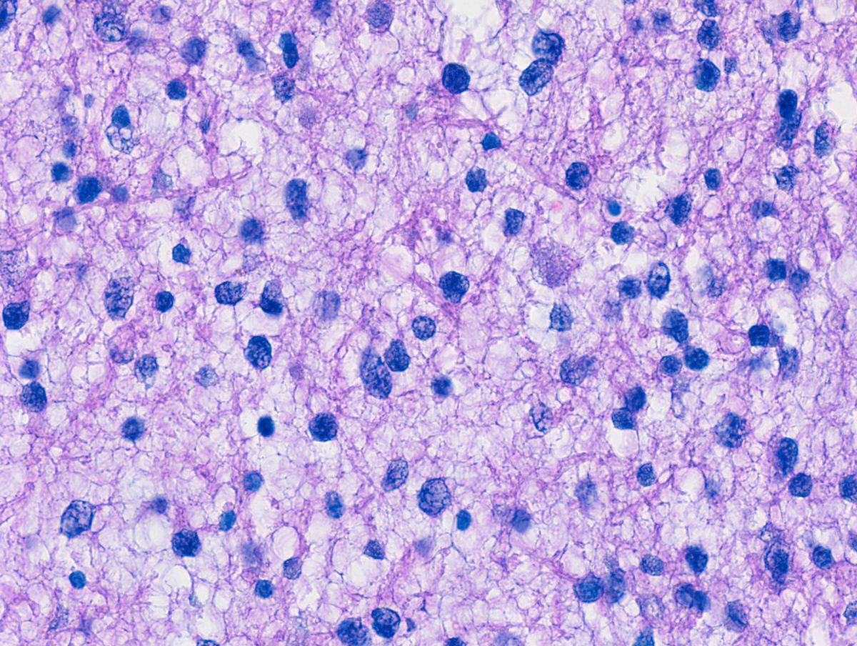 Astrocytoma Brain Tumor Slide