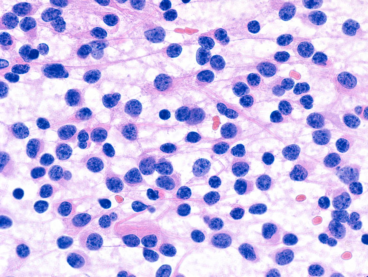 Oligodendroglioma Brain Tumor Slide