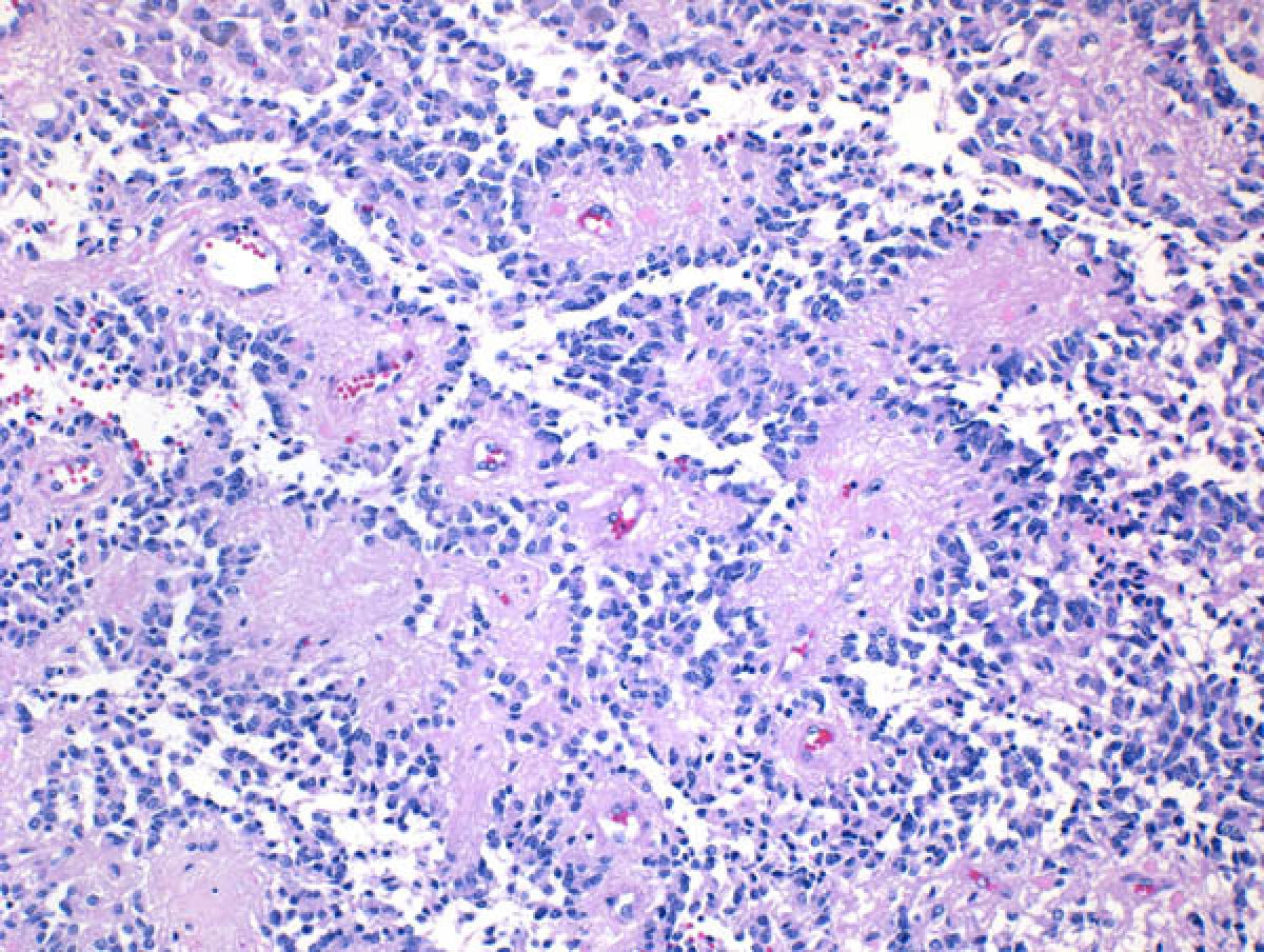 Ependymoma Brain Tumor Slide