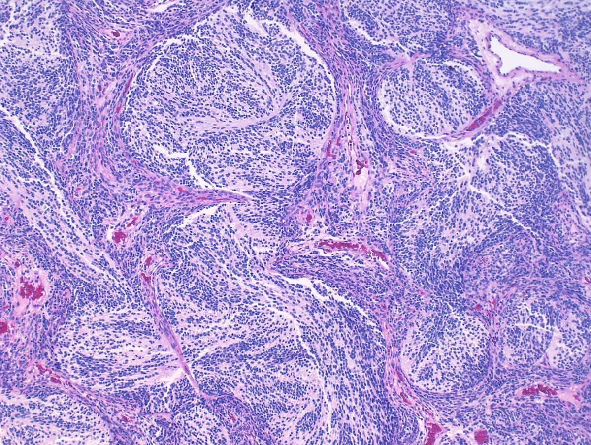 Medulloblastoma Brain Tumor Slide