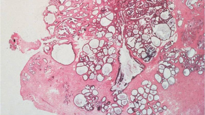 Benign Fibrocystic Changes