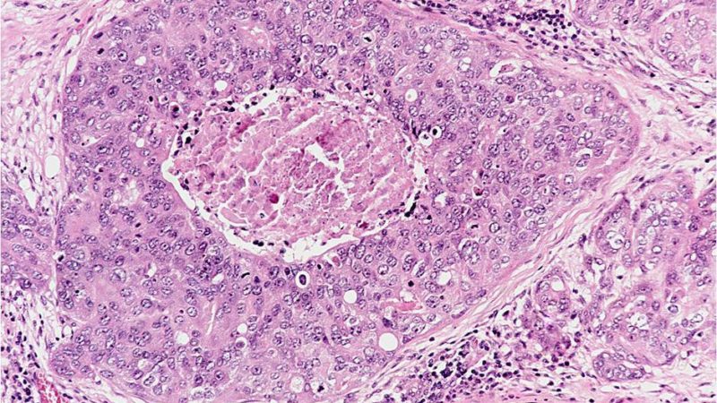 Adipose tissue infiltration of cancer cells into various organs.