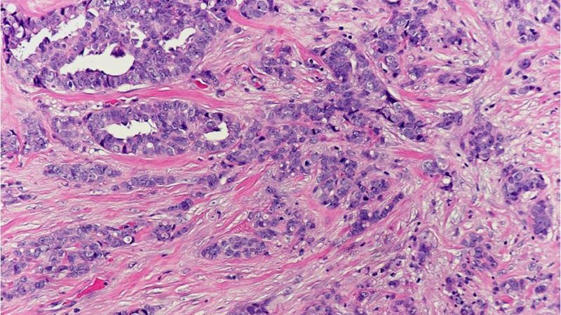 Two types of breast carcinomas based on a structural pattern