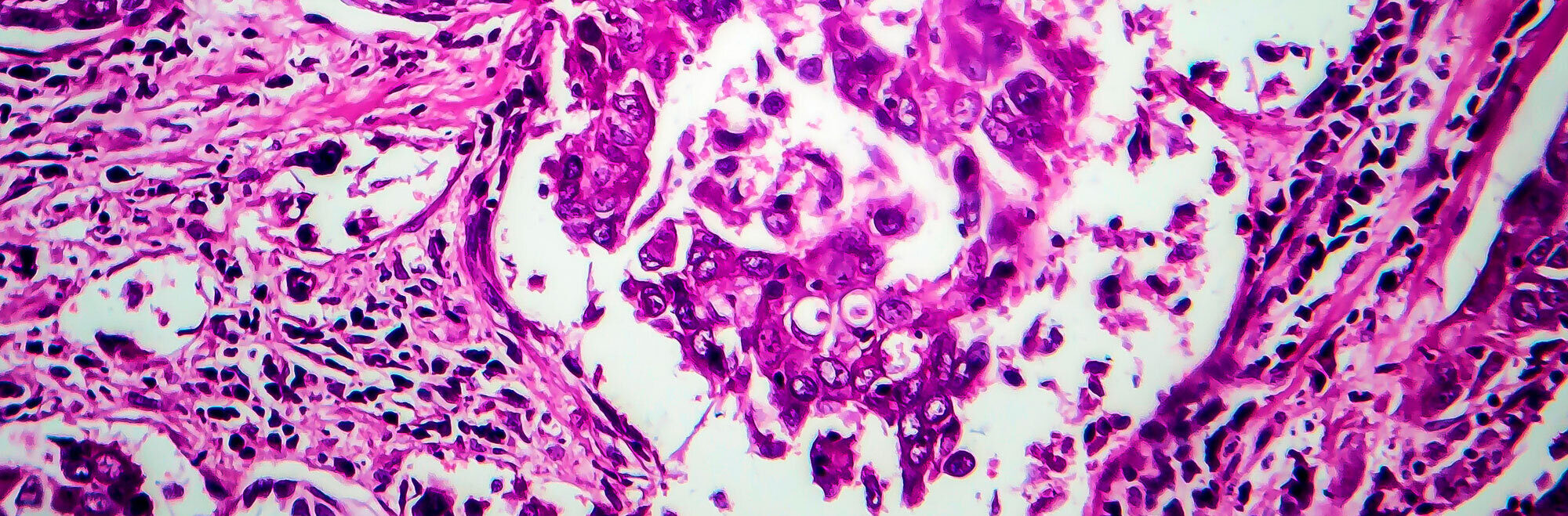 Breast ductal carcinoma