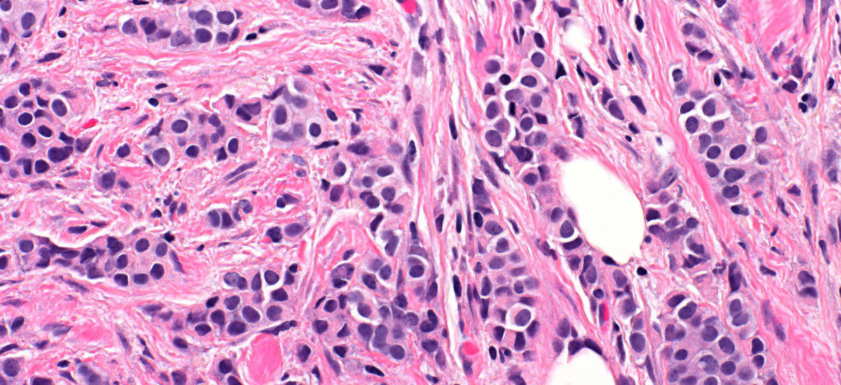 Invasive Lobular Carcinoma Photomicrograph