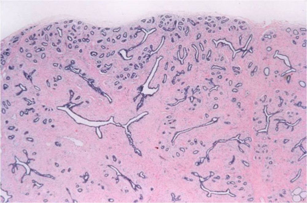 Benign Fibroadenoma