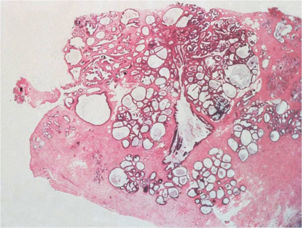 Benign Fibrocystic Changes