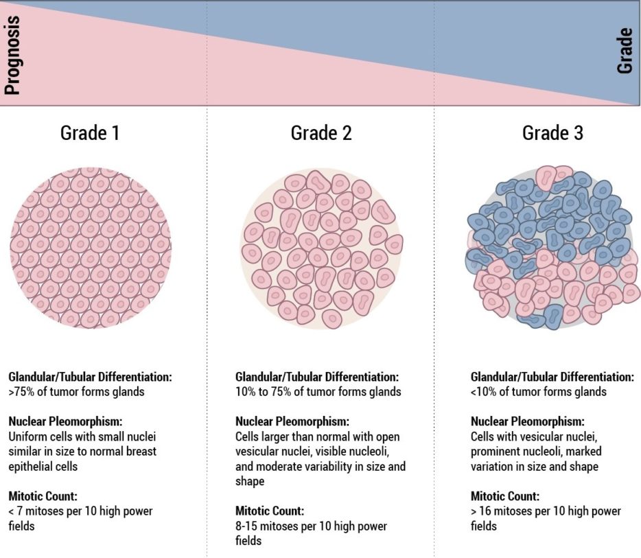 Idc Breast Cancer Size at Viola Gutierrez blog