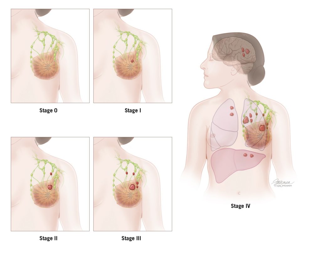 Stages of Breast Cancer Illustration