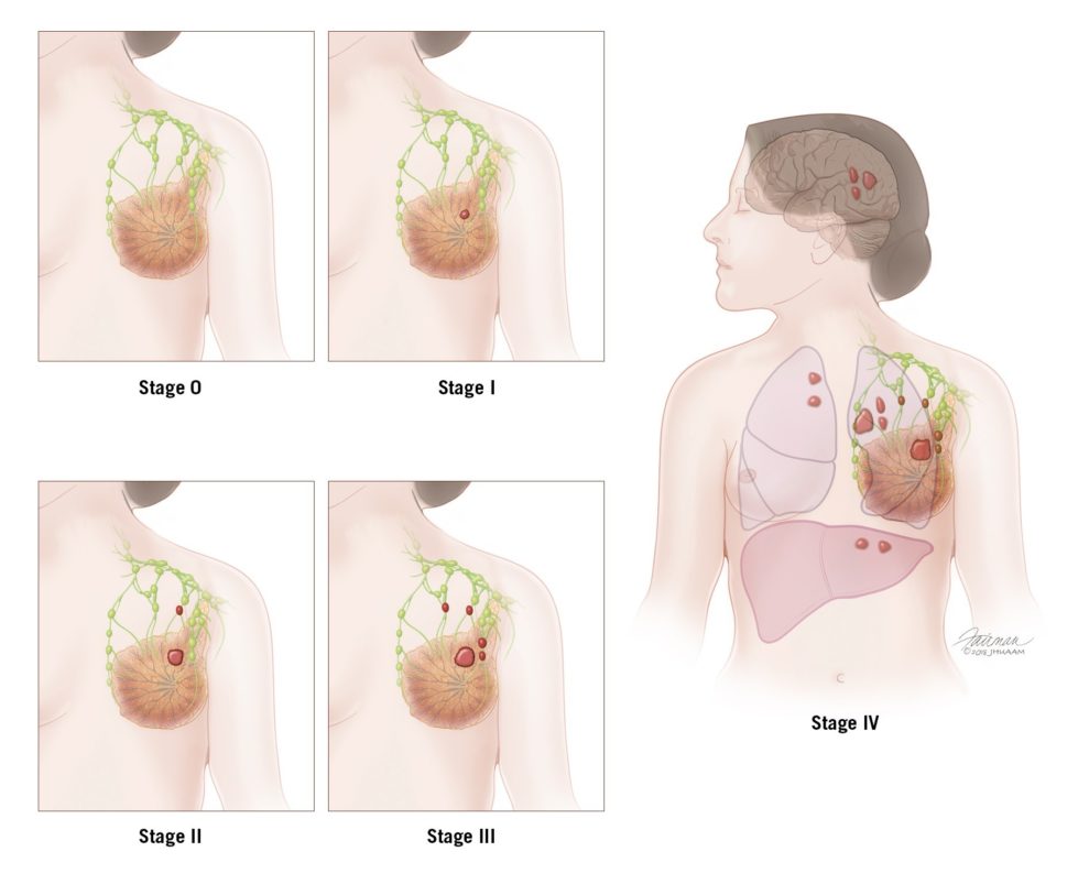 Lack of breast development in a 16-year-old girl. Note multiple