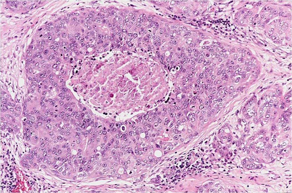 Ductal Carcinoma
