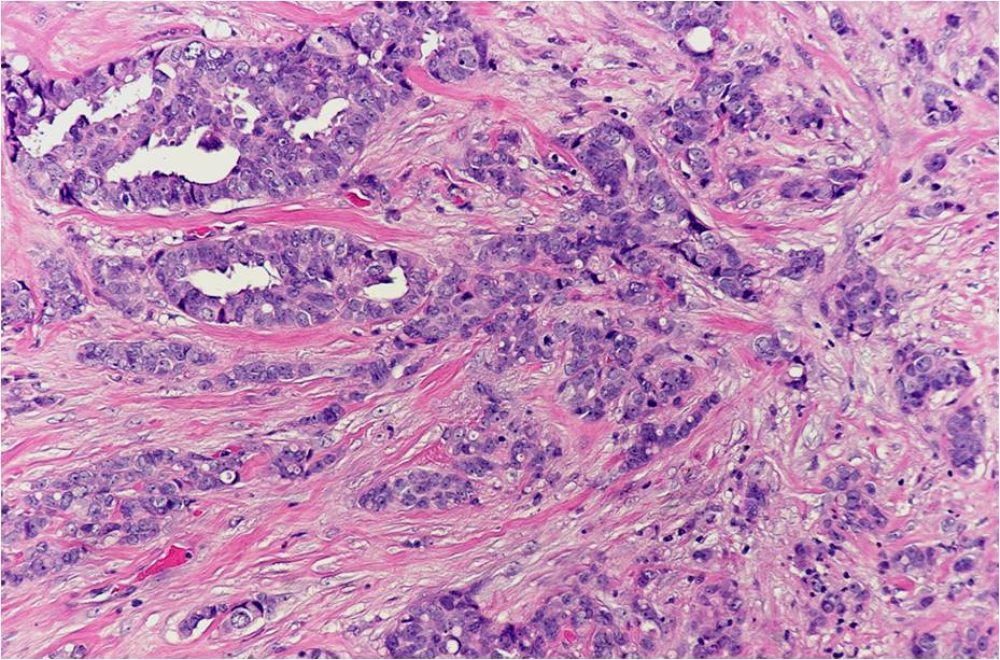 Invasive Ductal Carcinoma
