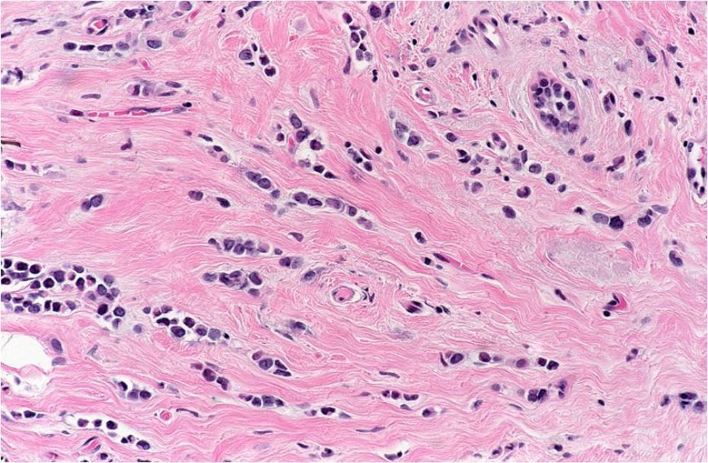 Invasive Lobular Carcinoma