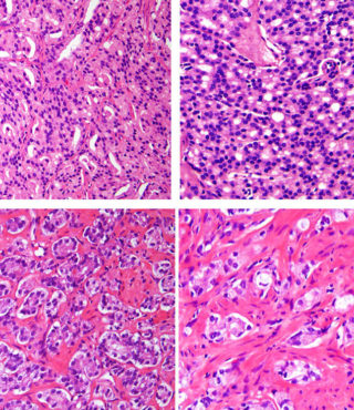 About - Urologic Pathology Division | Johns Hopkins Pathology