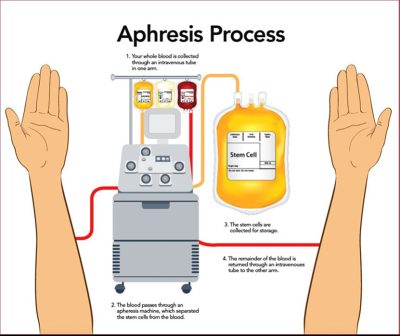 Apheresis process diagram