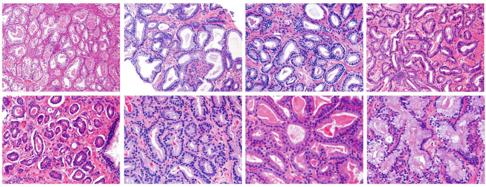 Gleason Patterns 1-3