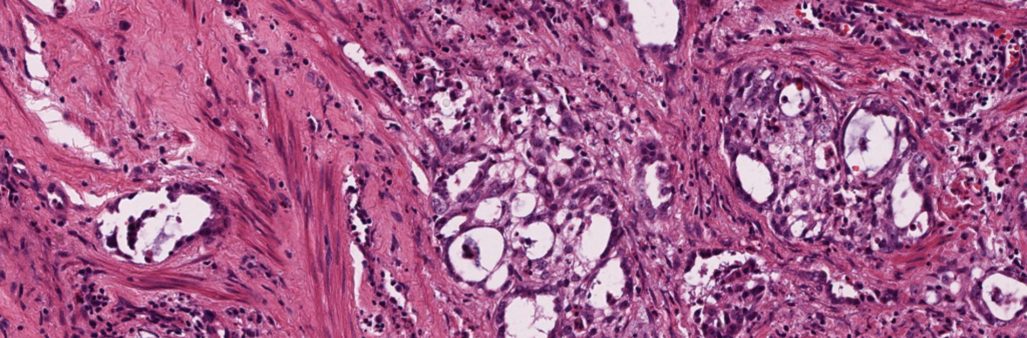 Urethra adenocarcinoma