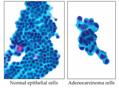 Epithelial and adenocarcinoma cells