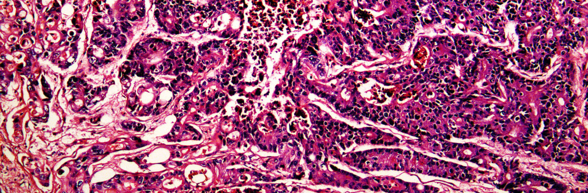 Pathology liver cancer slide