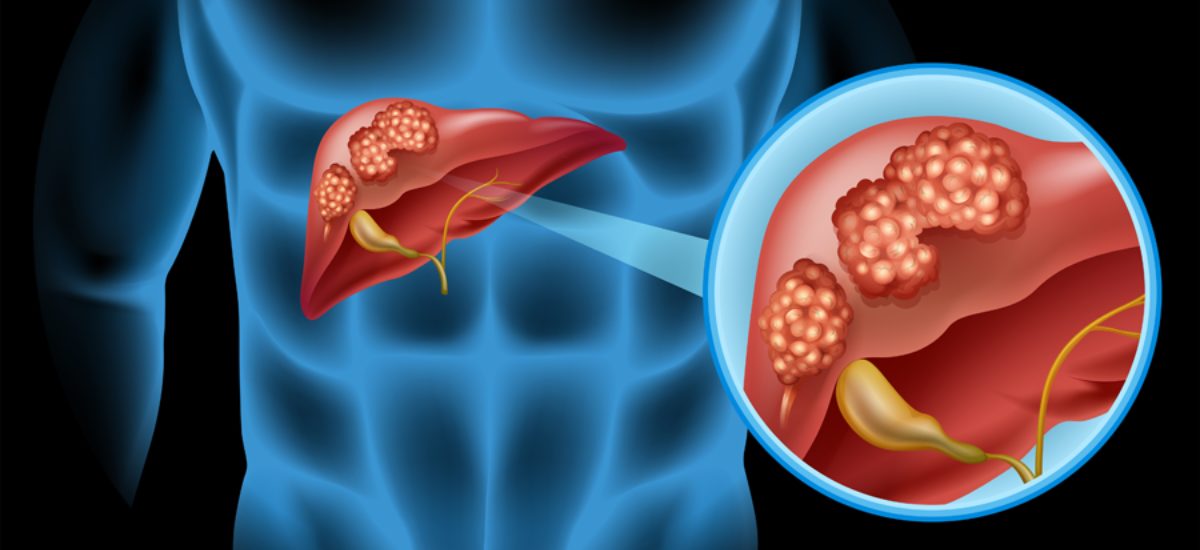 Liver cancer illustration