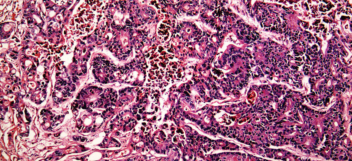 Liver cancer pathology slide
