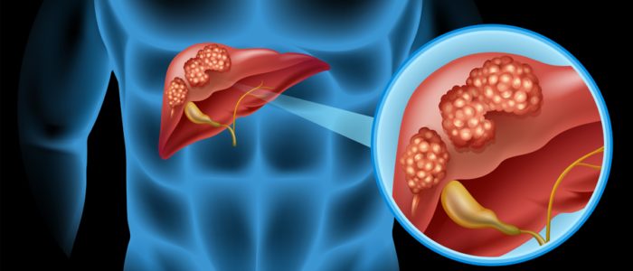 Liver Cancer - Liver Cancer | Johns Hopkins Pathology