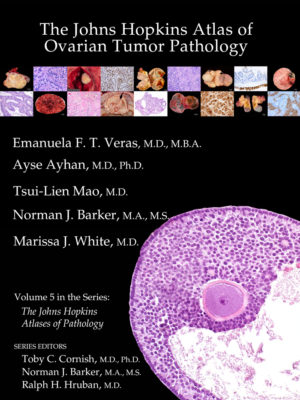 Atlas ovarian tumor