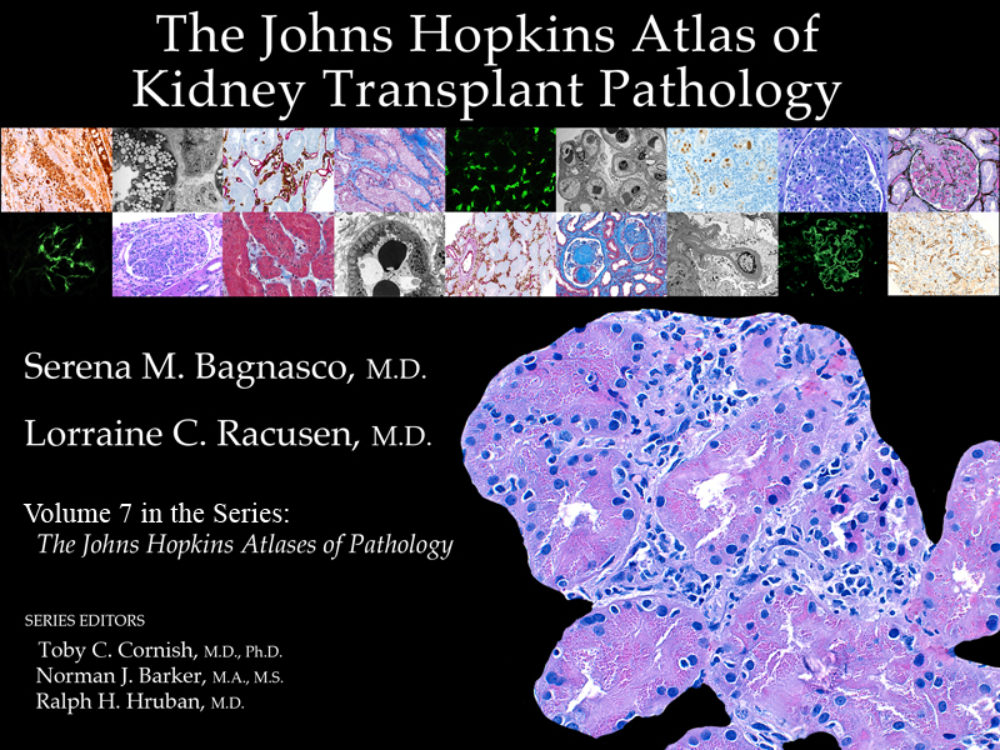 Atlas renal transplant