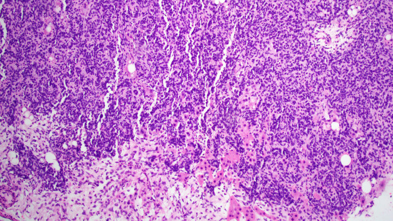 Sertoli-Leydig Cell Ovarian Tumor