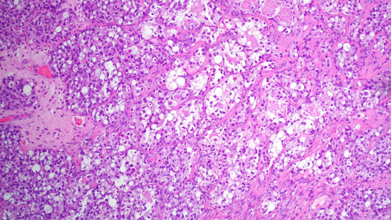 Clear Cell Carcinoma Epithelial Tumor