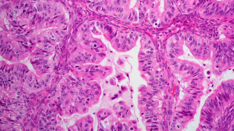 Mucinous Carcinoma Epithelial Tumor