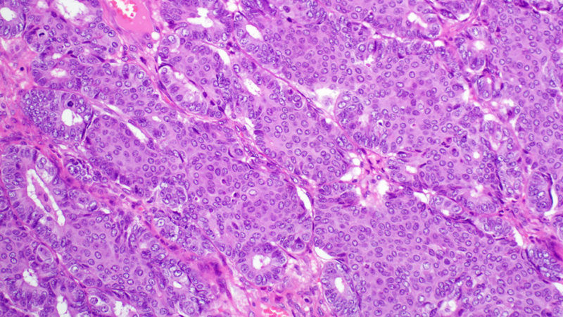 Types Of Ovarian Tumors Ovarian Cancer Johns Hopkins Pathology