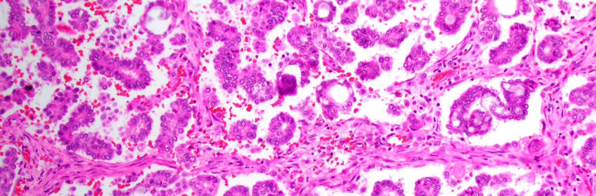 Low-Grade Serous Carcinoma Epithelial Tumor
