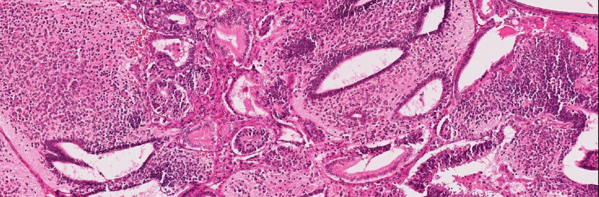 Ovarian pathology slide