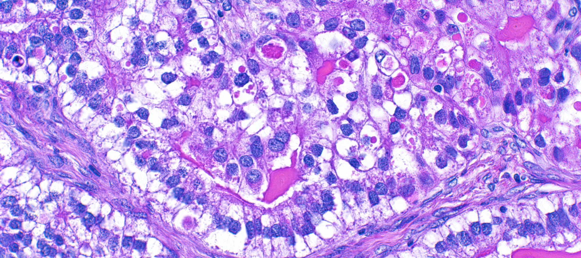 Ovarian cancer pathology slide